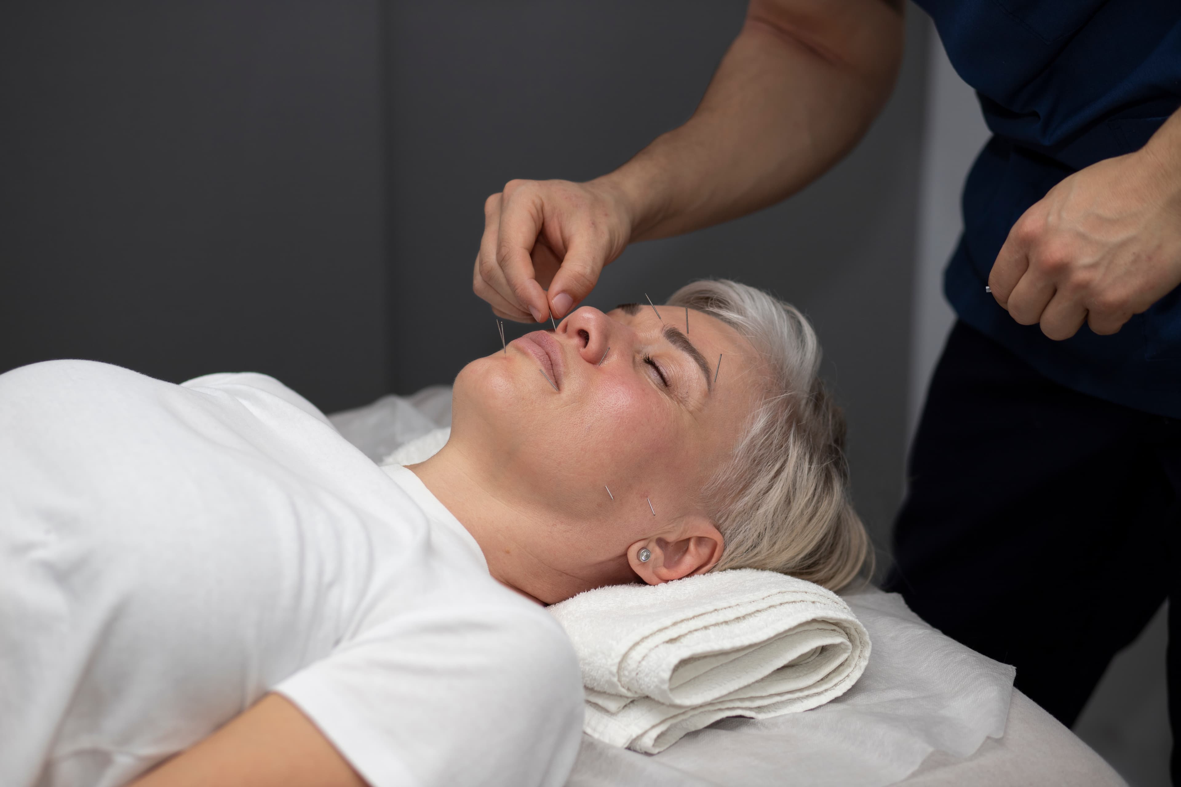 Acupuncture
